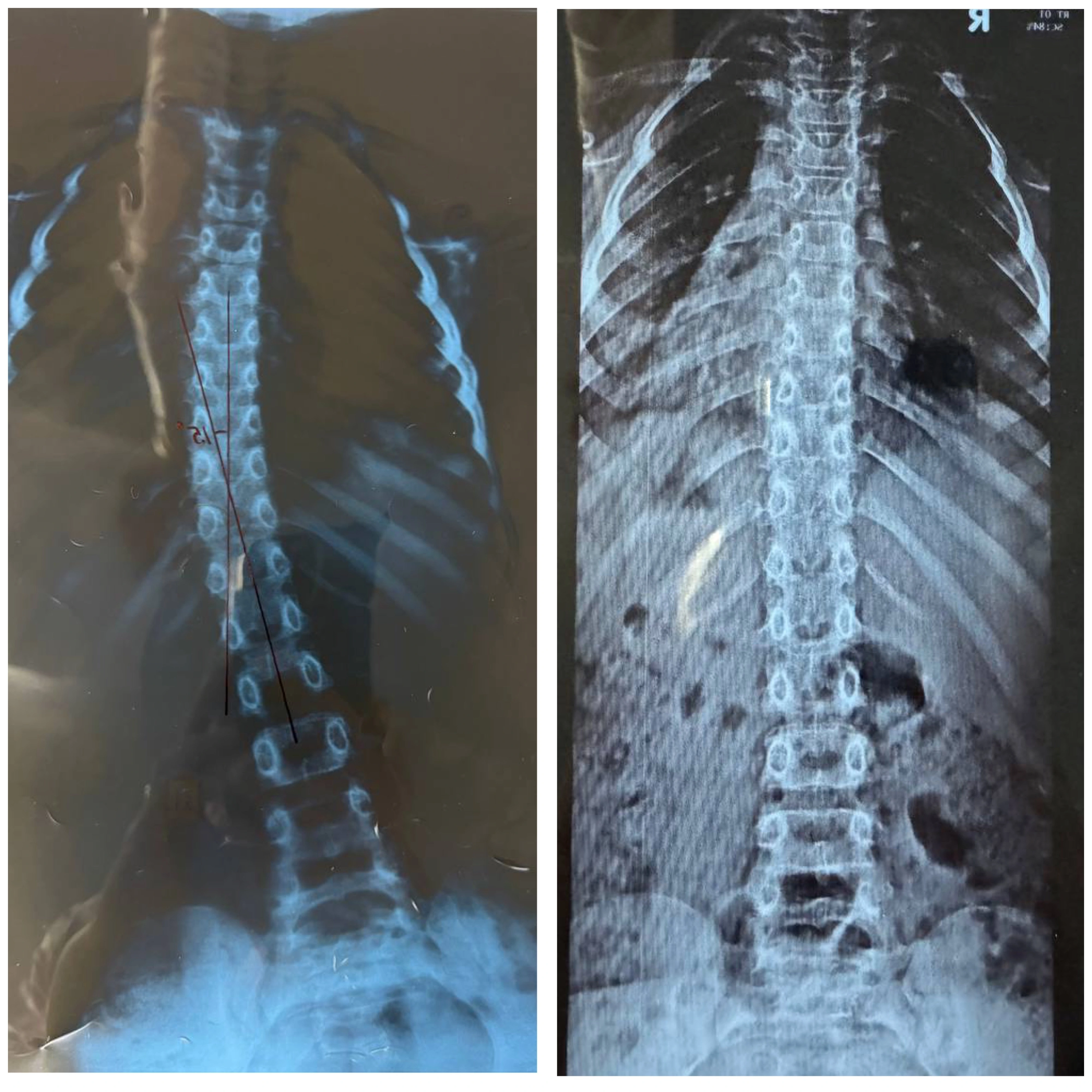 Итог — рентген До и После